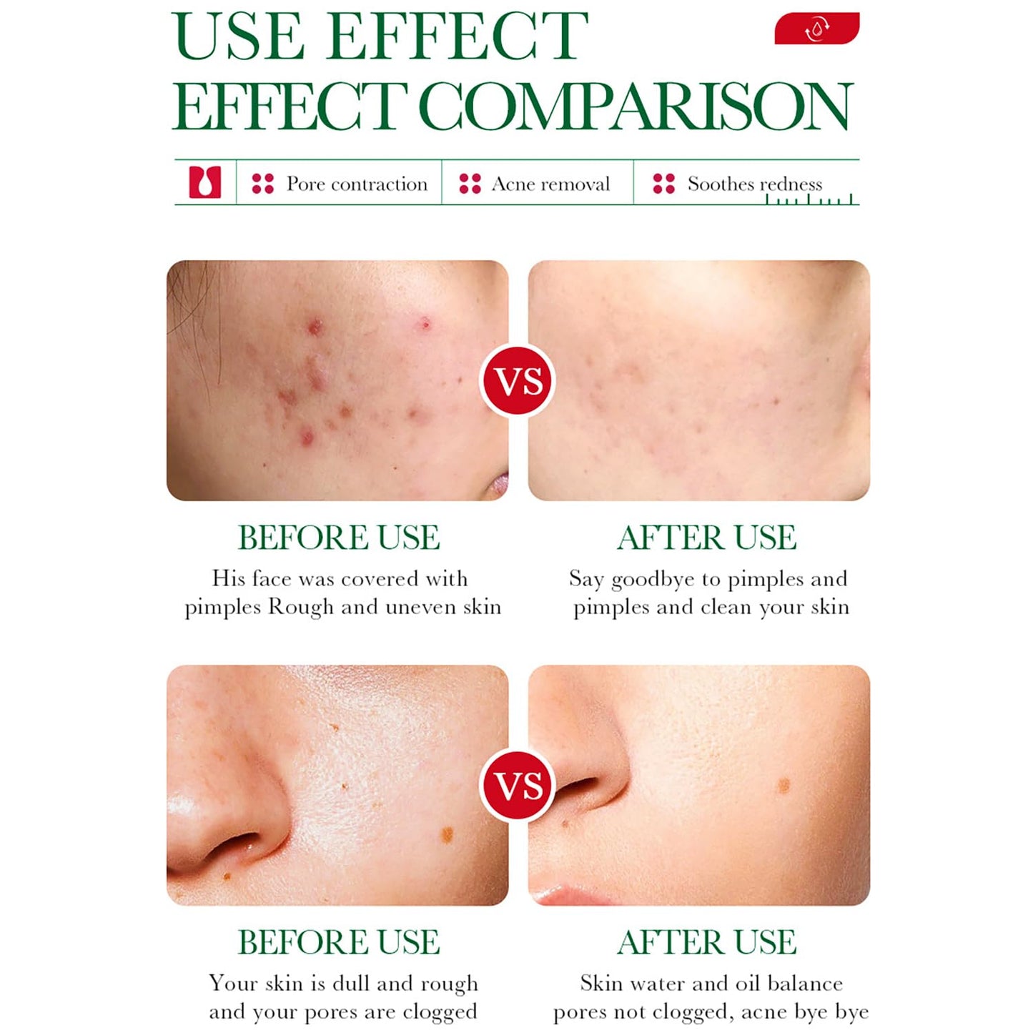Salicylic Acid Acne Set